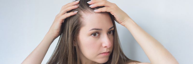 Alopecie přichází už v pubertě